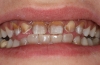 Силно оцветени зъби след препариране за фасети