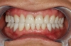 Пациент с изработени зъби от е.мах пълен контур