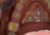 Гингивална протеза на долни зъби.