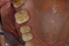 Вид на тгорните зъби с треми без протезата